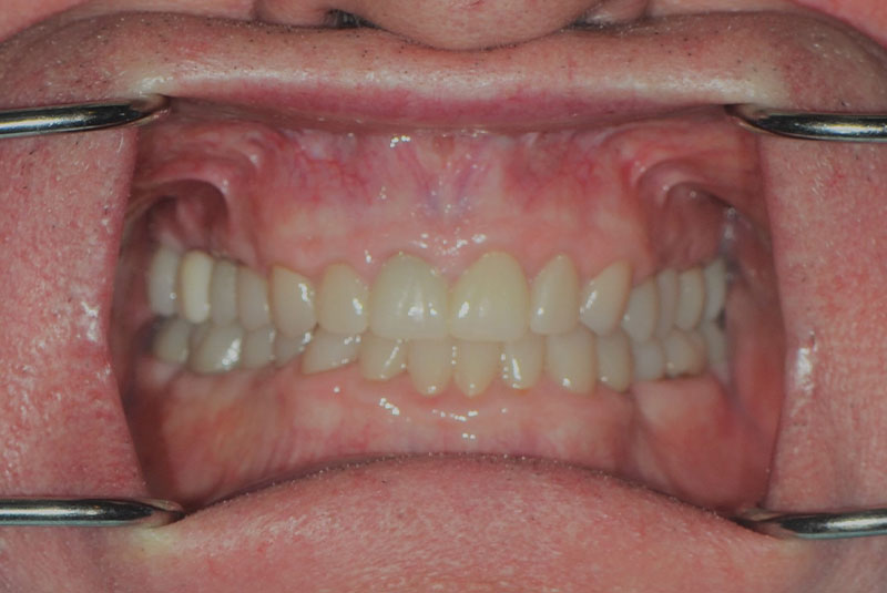after dental treatment