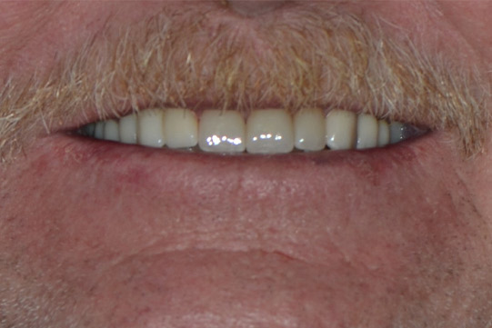 Before and after 4