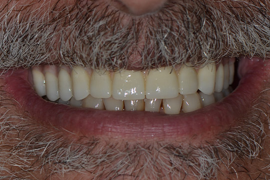 before and after 10