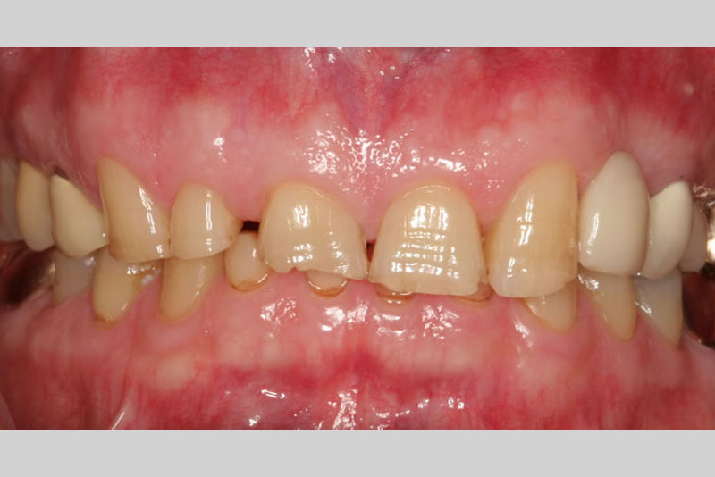 crowns case1 before
