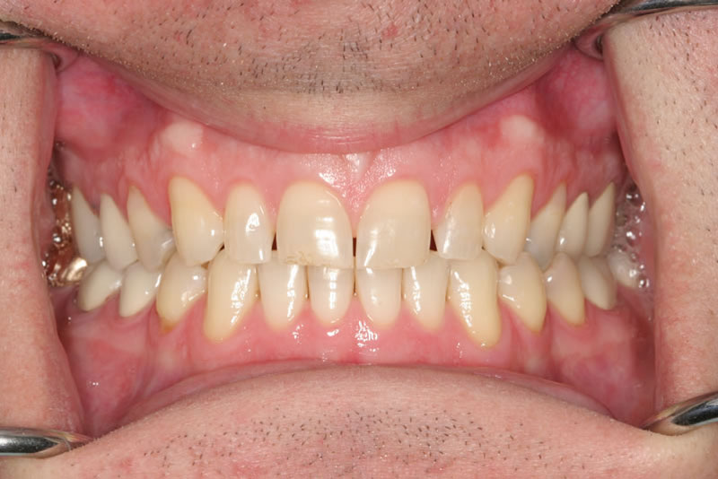 crowns case4 before