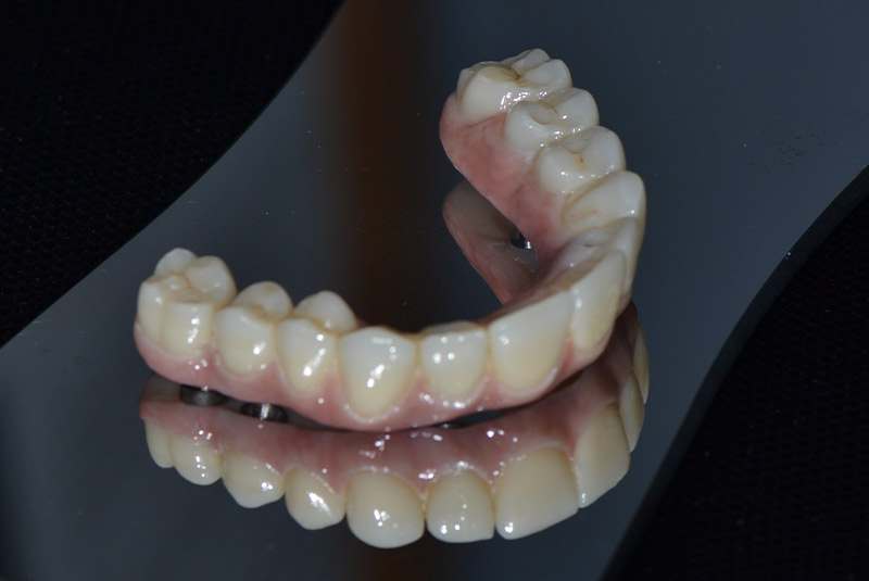Teeth-in-a-day
