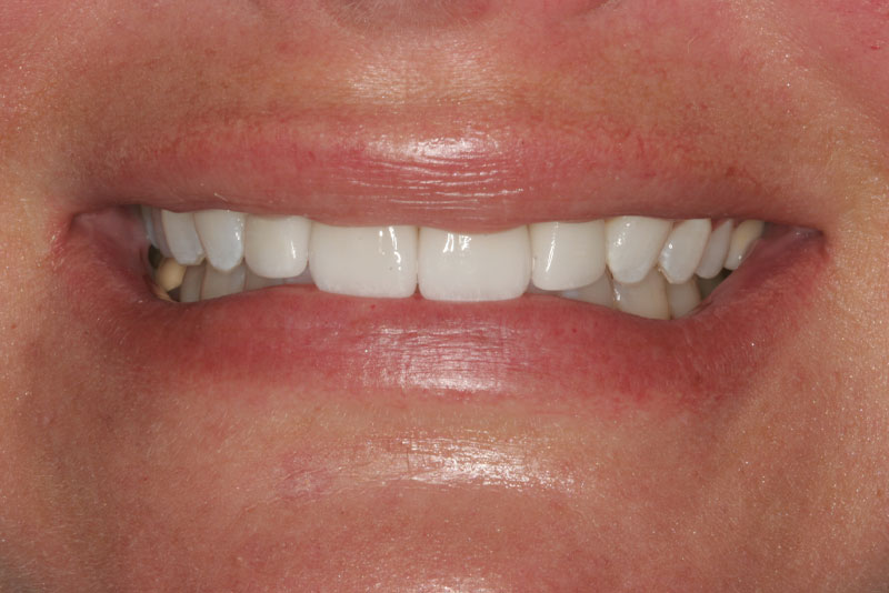 sm case1 after